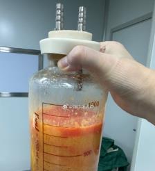 东阳水动力吸脂手术要做多久？